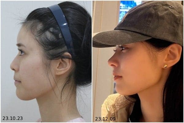 코성형 병원 선택 전 확인할 4가지 기준 — 디자인·재료·기능·시스템 관련 이미지 2/9