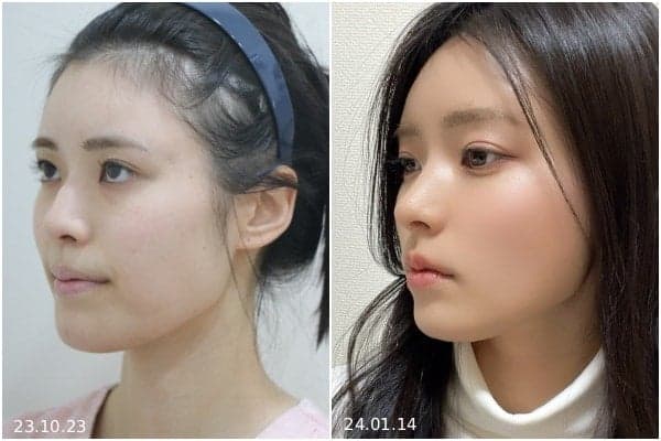 코성형 병원 선택 전 확인할 4가지 기준 — 디자인·재료·기능·시스템 관련 이미지 6/9
