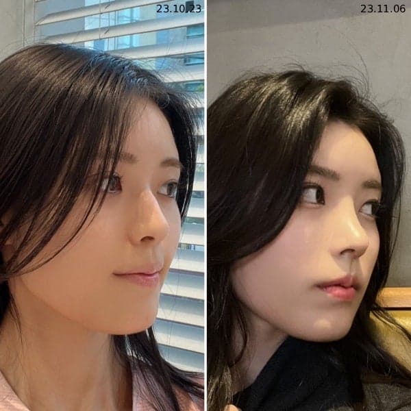 코성형 병원 선택 전 확인할 4가지 기준 — 디자인·재료·기능·시스템 관련 이미지 9/9