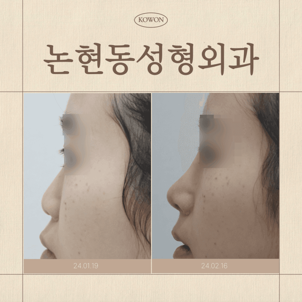 คลินิกการผ่าตัดจมูก: เกณฑ์ที่ควรพิจารณา ภาพถ่ายก่อนและหลังการผ่าตัด — การเลือกวัสดุและรายการตรวจสอบการปรึกษา ภาพประกอบ 1/7