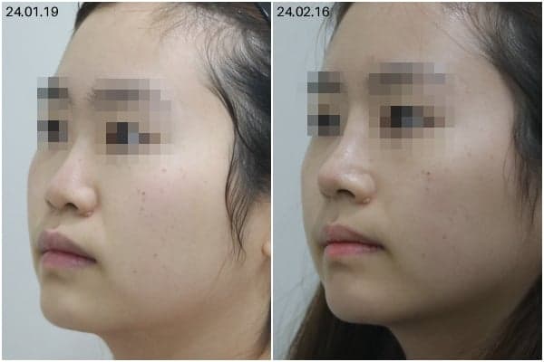 코수술 병원, 전후 사진보다 먼저 봐야 할 기준 — 재료 선택과 상담 확인 항목 관련 이미지 2/7