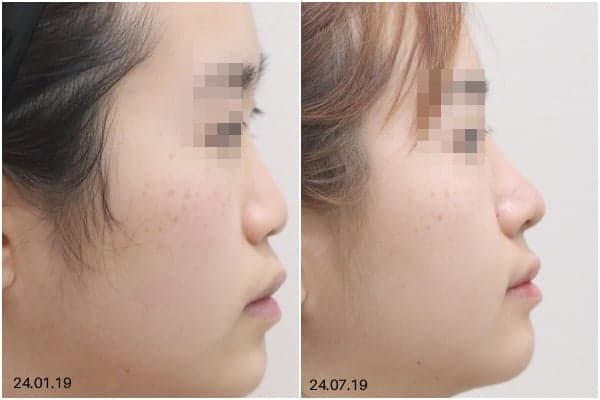 코수술 병원, 전후 사진보다 먼저 봐야 할 기준 — 재료 선택과 상담 확인 항목 관련 이미지 6/7