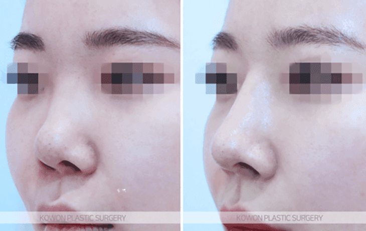 코수술 한 달 붓기, 어느 정도가 정상인가요 — 비대칭·코끝 촉감 질문에 답하다 관련 이미지 4/10