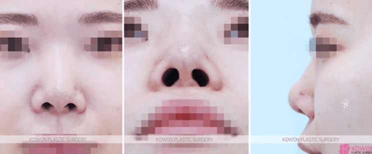 코수술 한 달 붓기, 어느 정도가 정상인가요 — 비대칭·코끝 촉감 질문에 답하다 관련 이미지 5/10