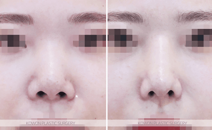 코수술 한 달 붓기, 어느 정도가 정상인가요 — 비대칭·코끝 촉감 질문에 답하다 관련 이미지 6/10