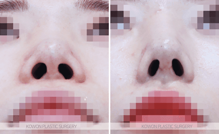 코수술 한 달 붓기, 어느 정도가 정상인가요 — 비대칭·코끝 촉감 질문에 답하다 관련 이미지 7/10