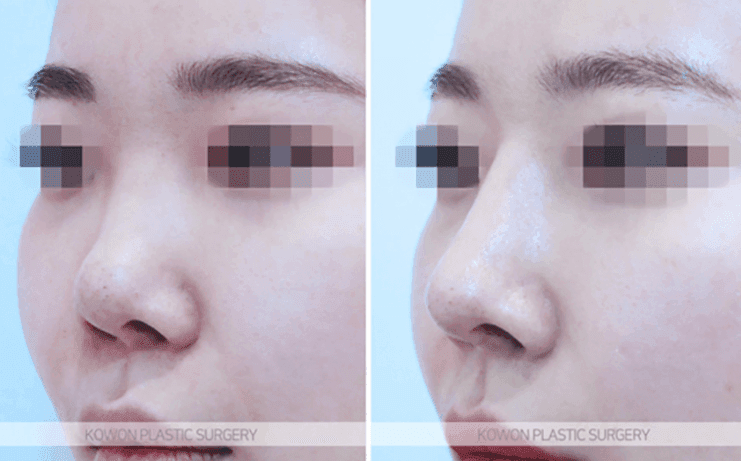 코수술 한 달 붓기, 어느 정도가 정상인가요 — 비대칭·코끝 촉감 질문에 답하다 관련 이미지 8/10