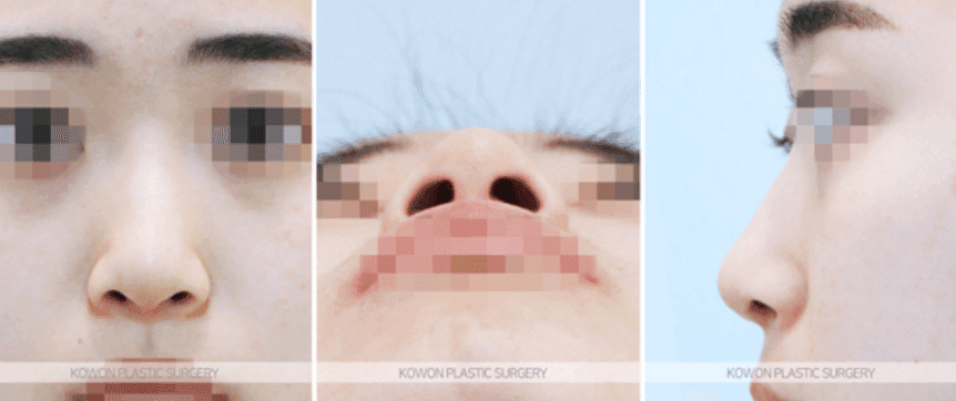 코수술 일주일차, 지금 모습이 결과일까요 — 붓기 변화와 실리콘 제거 질문 정리 관련 이미지 3/8