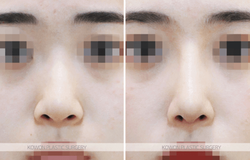 코수술 일주일차, 지금 모습이 결과일까요 — 붓기 변화와 실리콘 제거 질문 정리 관련 이미지 4/8