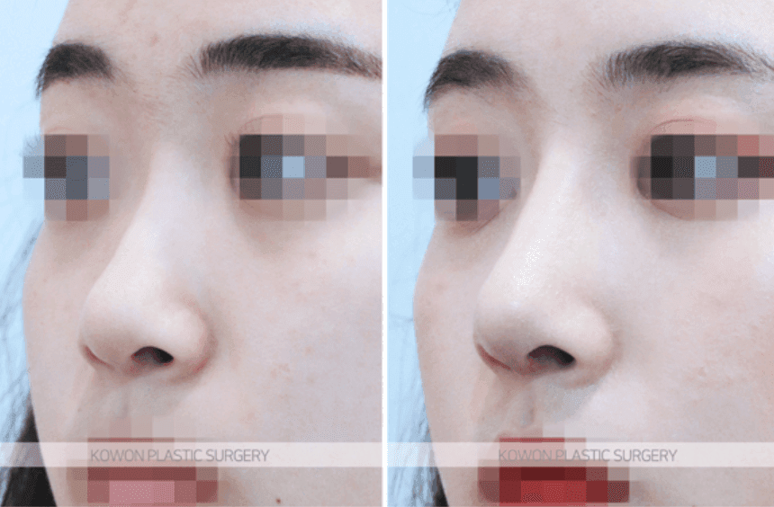 Image 6/8 for: one-week swelling and silicone removal questions