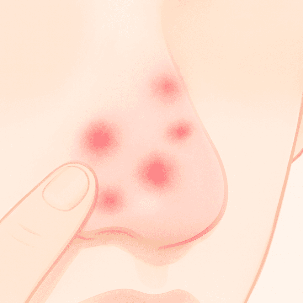 코성형 후 통증, 염증이 문제일 수 있습니다 — 붓기와 구분하는 신호 5가지 관련 이미지 2/7
