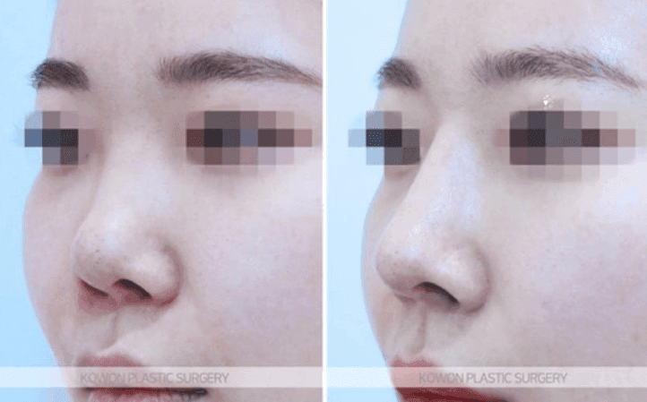 코수술 회복기간 중 코 안쪽에 뭔가 만져진다면 — 염증인지 정상 회복인지 구분하는 법 관련 이미지 5/11
