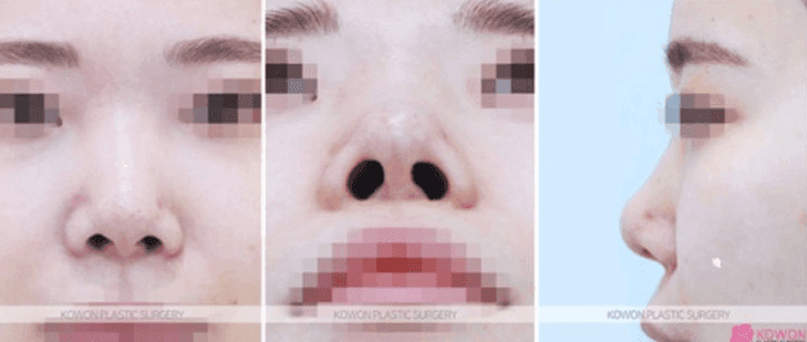 หากคุณรู้สึกว่ามีอะไรบางอย่างอยู่ในจมูกระหว่างพักฟื้นการผ่าตัดจมูก— วิธีแยกแยะระหว่างการอักเสบและการฟื้นตัวตามปกติ ภาพประกอบ 6/11