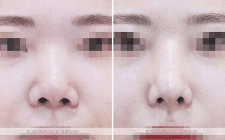 코수술 회복기간 중 코 안쪽에 뭔가 만져진다면 — 염증인지 정상 회복인지 구분하는 법 관련 이미지 7/11