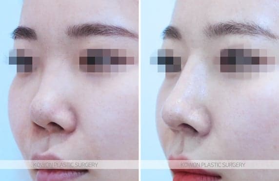코수술 후 콧물이 흐르고 코가 간지러워요 — 염증 증상일까? 질문 세 가지 정리 관련 이미지 3/5