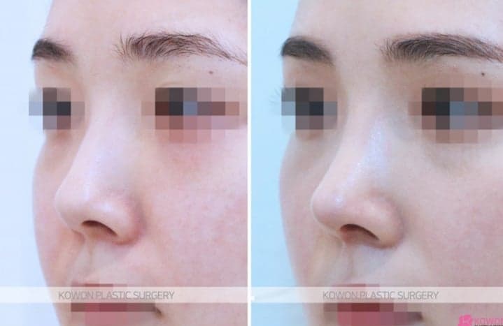 코수술 후 콧물이 흐르고 코가 간지러워요 — 염증 증상일까? 질문 세 가지 정리 관련 이미지 5/5