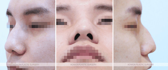 코수술 붓기 기간, 얼마나 걸리나요 — 직후 변화와 회복 흐름 관련 이미지 4/9