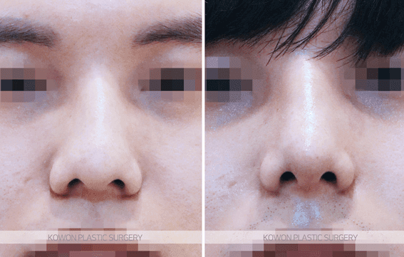 코수술 붓기 기간, 얼마나 걸리나요 — 직후 변화와 회복 흐름 관련 이미지 5/9