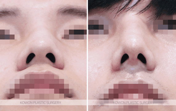 코수술 붓기 기간, 얼마나 걸리나요 — 직후 변화와 회복 흐름 관련 이미지 6/9