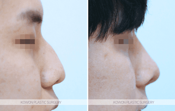 코수술 붓기 기간, 얼마나 걸리나요 — 직후 변화와 회복 흐름 관련 이미지 8/9