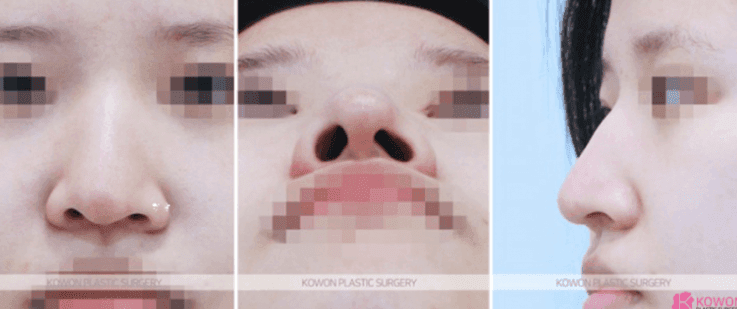 코수술 5개월 뒤에도 콧등이 빨갛게 붓는다면 — 괜찮은 붓기와 점검이 필요한 붓기 관련 이미지 4/9