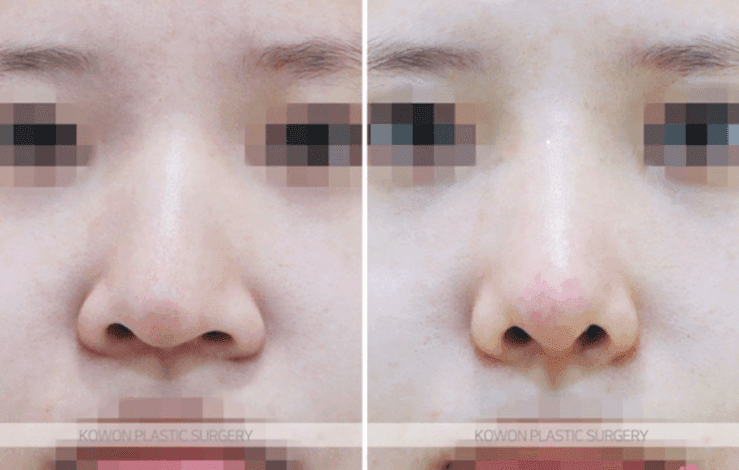 코수술 5개월 뒤에도 콧등이 빨갛게 붓는다면 — 괜찮은 붓기와 점검이 필요한 붓기 관련 이미지 6/9