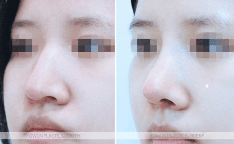 코수술 5개월 뒤에도 콧등이 빨갛게 붓는다면 — 괜찮은 붓기와 점검이 필요한 붓기 관련 이미지 7/9
