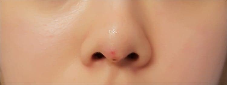 코수술 붓기, 빨리 빼는 방법과 염증을 구분하는 신호 관련 이미지 4/6