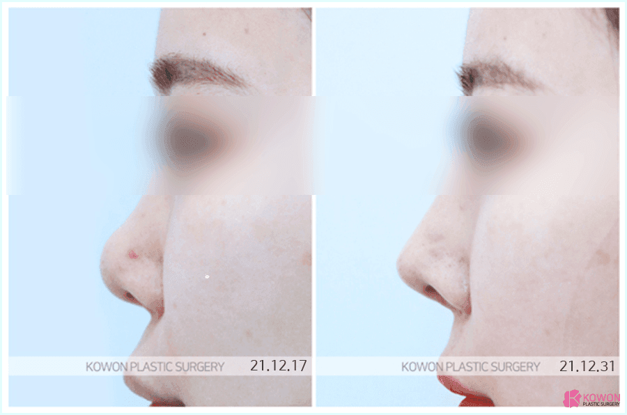 늑연골코성형을 알아볼 때 확인하는 세 가지 — 와핑, 원하는 형태, 회복 기간 관련 이미지 2/8