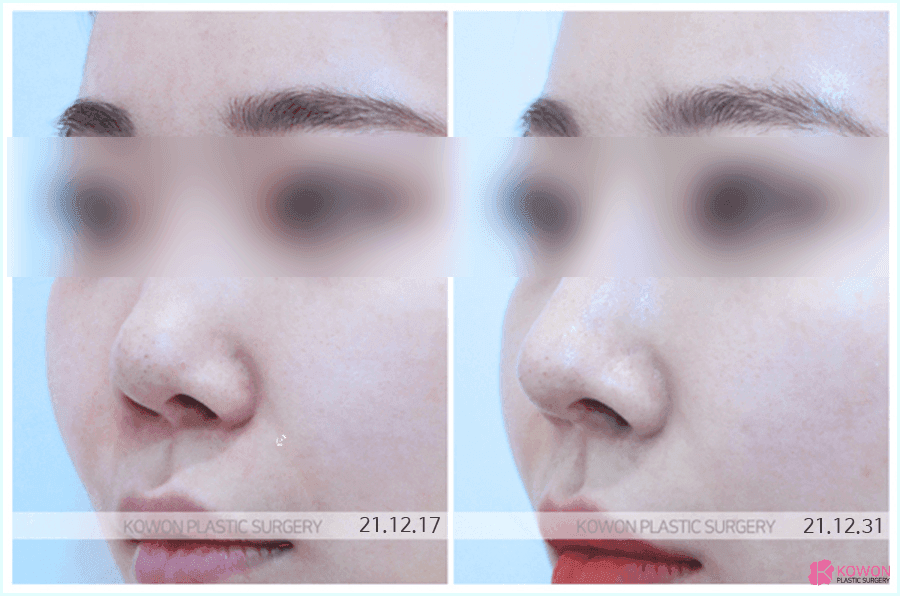 늑연골코성형을 알아볼 때 확인하는 세 가지 — 와핑, 원하는 형태, 회복 기간 관련 이미지 4/8