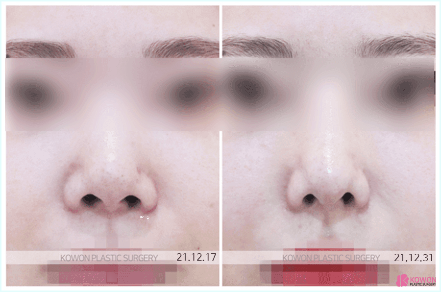 늑연골코성형을 알아볼 때 확인하는 세 가지 — 와핑, 원하는 형태, 회복 기간 관련 이미지 5/8