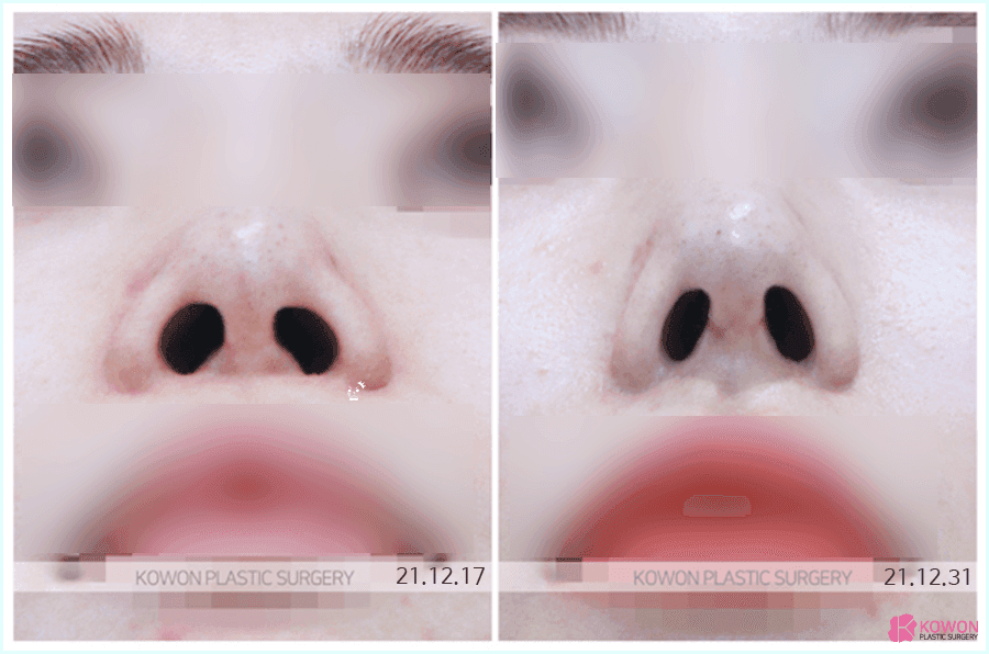 늑연골코성형을 알아볼 때 확인하는 세 가지 — 와핑, 원하는 형태, 회복 기간 관련 이미지 7/8