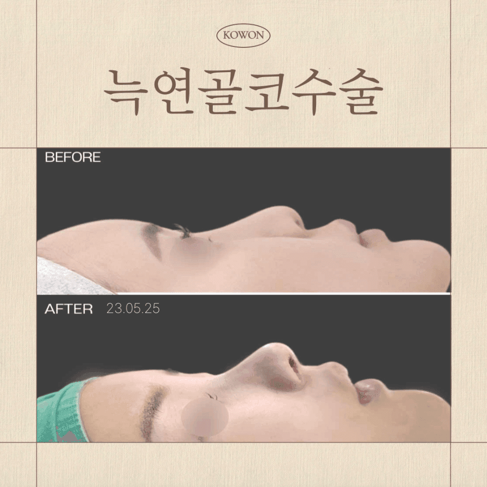 늑연골코수술로 무보형물코수술이 가능할까요? — 재료보다 구조를 먼저 보는 이유 관련 이미지 1/8