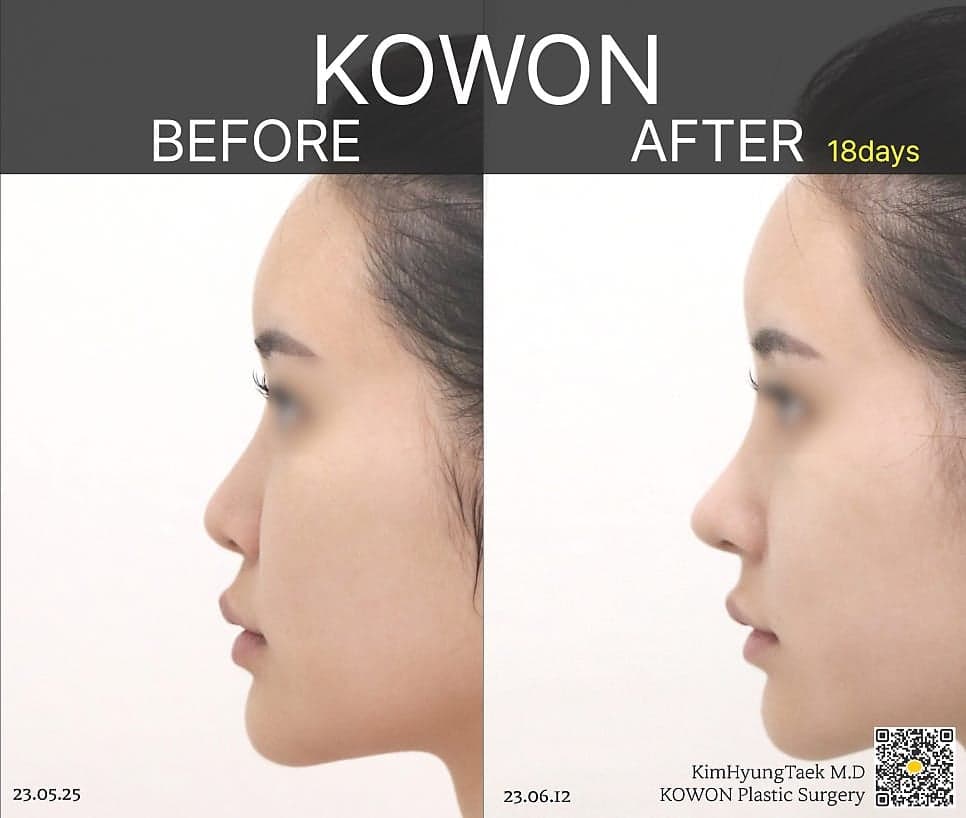 การผ่าตัดจมูก ไม่ใช้อิมแพลนต์สามารถทำได้ด้วยการผ่าตัดจมูก กระดูกอ่อนซี่โครงหรือไม่? — เหตุใดเราจึงพิจารณาโครงสร้างก่อนวัสดุ ภาพที่เกี่ยวข้อง 7/8