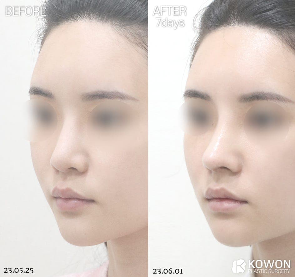 늑연골코수술로 무보형물코수술이 가능할까요? — 재료보다 구조를 먼저 보는 이유 관련 이미지 8/8
