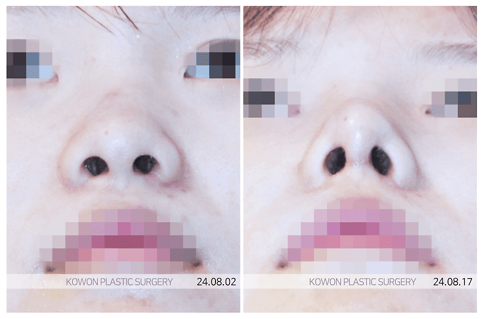 코끝이 시간이 지나며 퍼지는 이유 — 늑연골로 지지 구조를 세우는 접근 관련 이미지 5/5