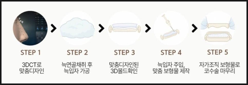자가늑입자 보형물 RIBFIT™ 리브핏은 어떻게 만드나요 — CT 기반 맞춤 몰드와 수술 단계 관련 이미지 2/5