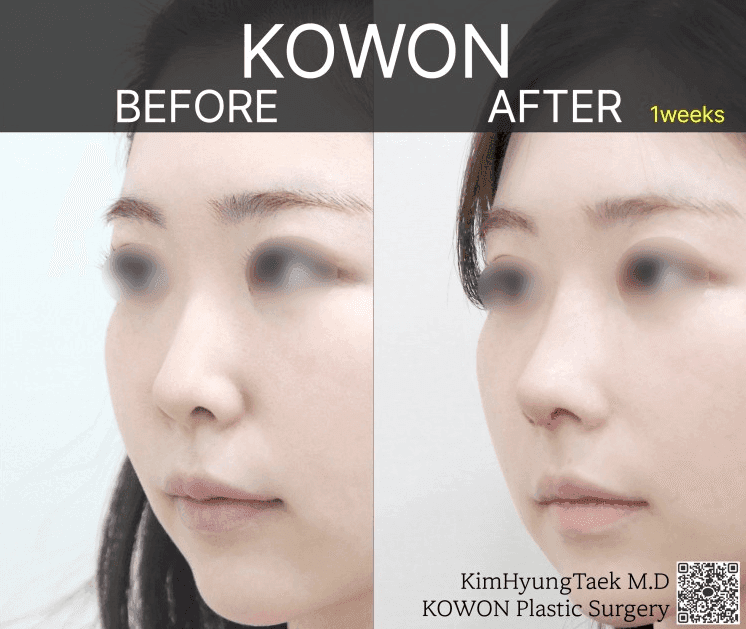 자가늑연골 맞춤 보형물(RIBFIT™ 리브핏)은 어떻게 수술하나요 — 와핑·흡수 문제와 회복 기간 관련 이미지 3/5