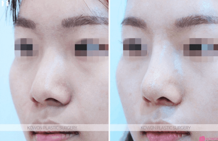 자가늑연골 맞춤 보형물(RIBFIT™ 리브핏)은 어떻게 수술하나요 — 와핑·흡수 문제와 회복 기간 관련 이미지 4/5