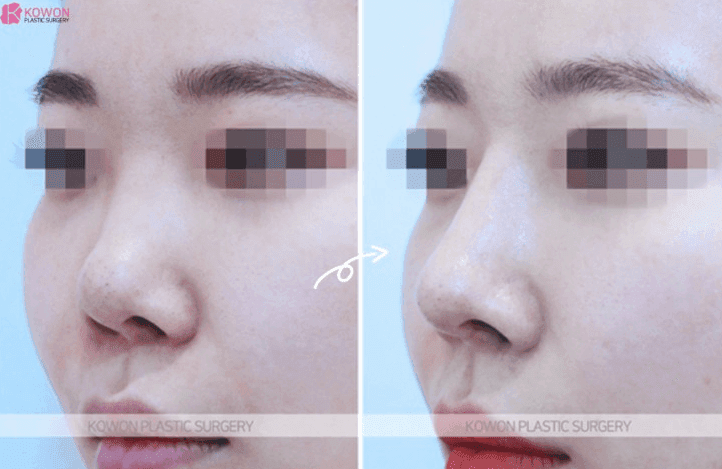 자가늑연골 맞춤 보형물(RIBFIT™ 리브핏)은 어떻게 수술하나요 — 와핑·흡수 문제와 회복 기간 관련 이미지 5/5