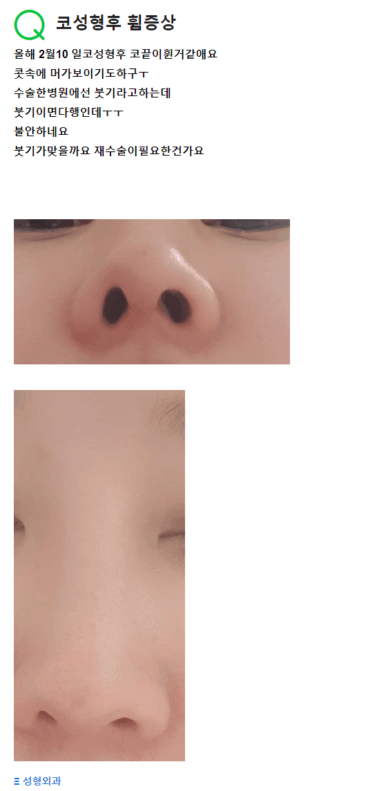코성형 후 비중격연골이 휘어진 것 같다면 — 붓기 판정과 점검 시점 관련 이미지 2/2