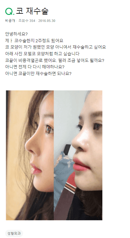 비중격 연골로 수술한 지 2주, 코재수술을 지금 정해도 될까요 관련 이미지 2/2