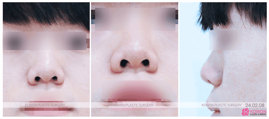 코성형 전후, 짧은 코끝을 비중격 연장술로 개선할 때 확인할 점 관련 이미지 3/9