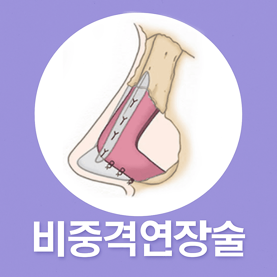 코성형 전후, 짧은 코끝을 비중격 연장술로 개선할 때 확인할 점 관련 이미지 4/9