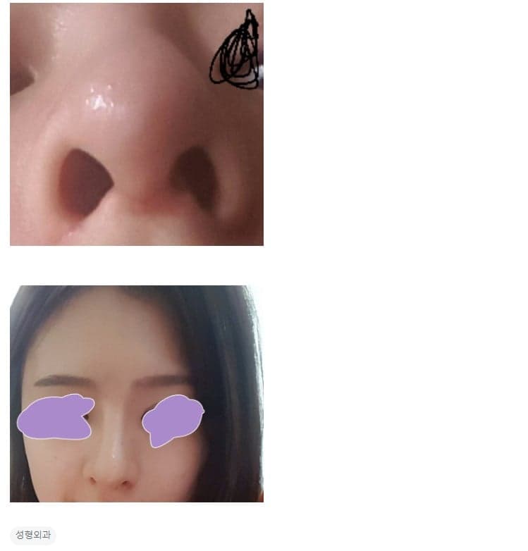 수술 2개월, 비중격연골이 한쪽으로 튀어나와 숨이 답답할 때 — 재수술 시기와 진료과 선택 관련 이미지 3/3