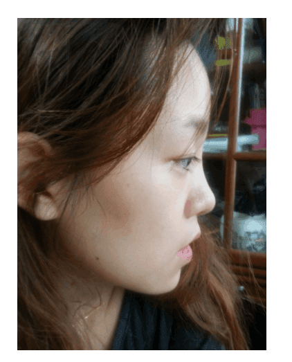 비중격코수술 6개월, 코끝이 딱딱하고 무거운 느낌 — 부작용일까요? 관련 이미지 3/3