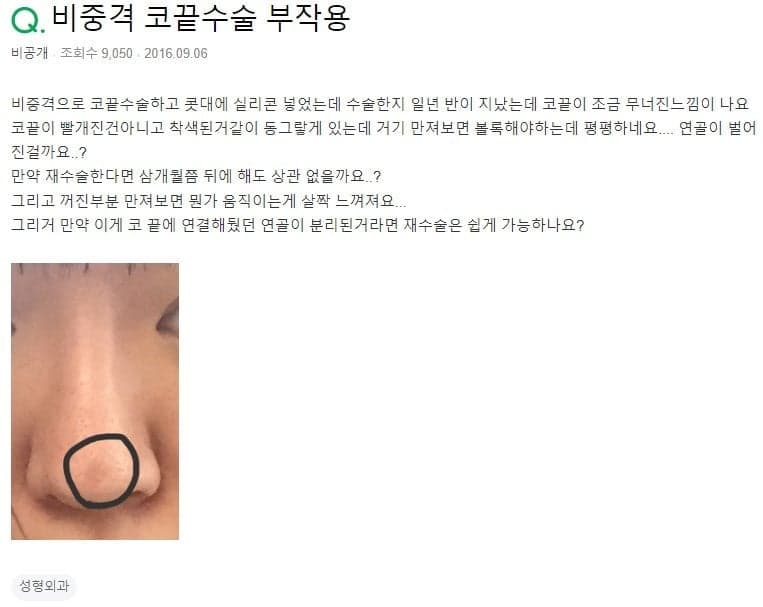 코끝수술 1년 6개월 뒤 코끝이 낮아진 느낌 — 연골이 벌어졌는지 확인하는 순서 관련 이미지 2/2