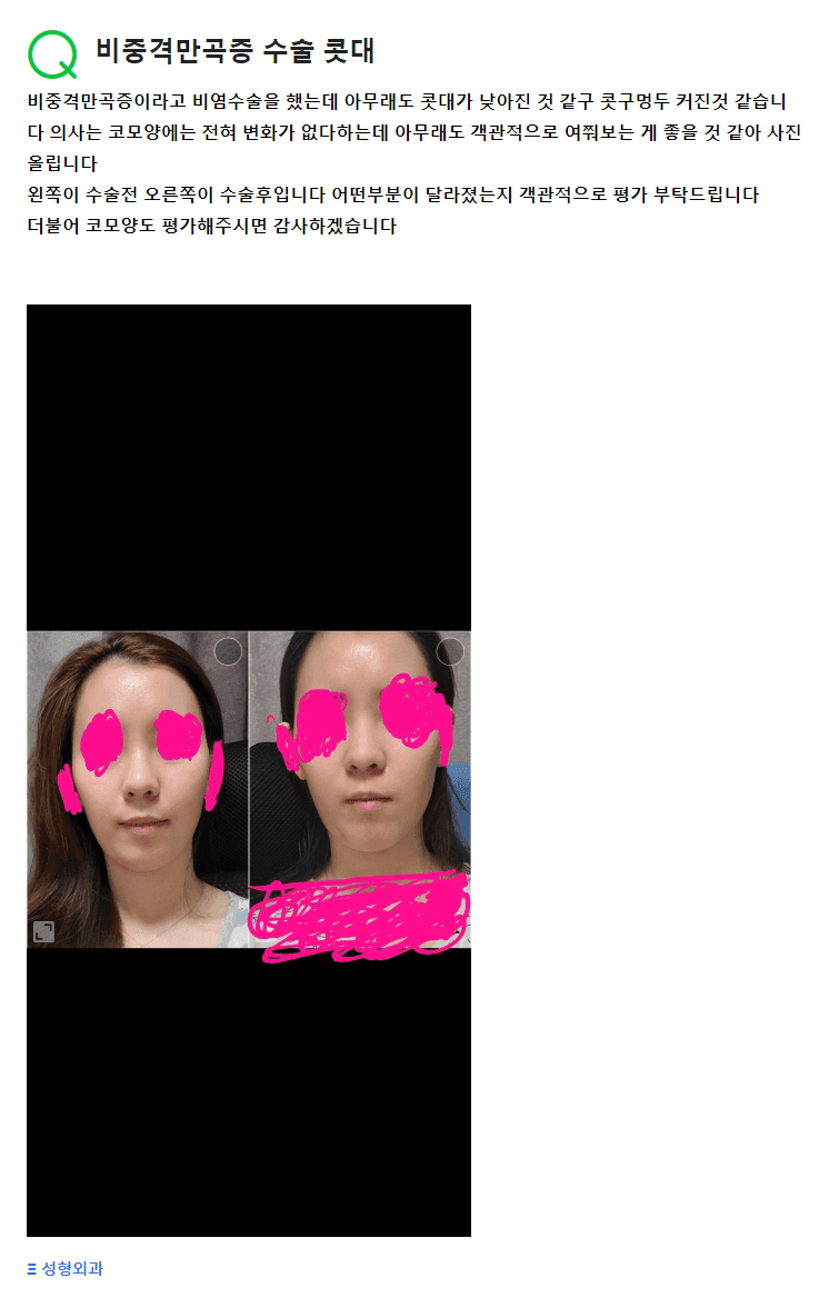 비중격만곡증 수술 뒤 콧대가 낮아진 것 같다면 — 정면 사진으로는 알 수 없는 것 (Q&A) 관련 이미지 2/2