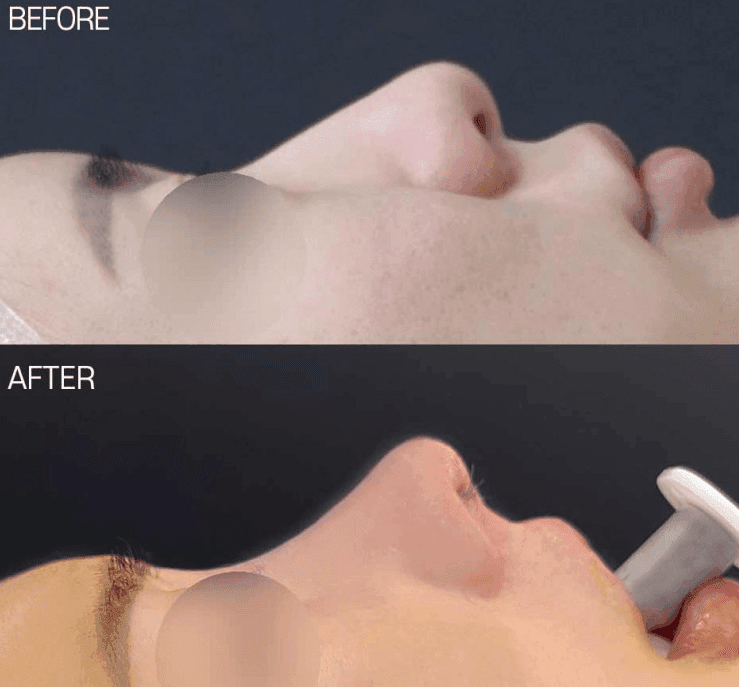Image 2/9 for: short nose rhinoplasty before/after — change process and recovery