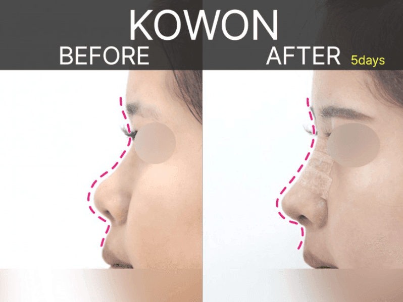 Image 6/9 for: short nose rhinoplasty before/after — change process and recovery